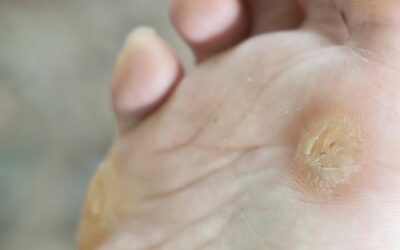 Tutto quello che c’è da sapere sulle verruche plantari: cause, diagnosi e rischi