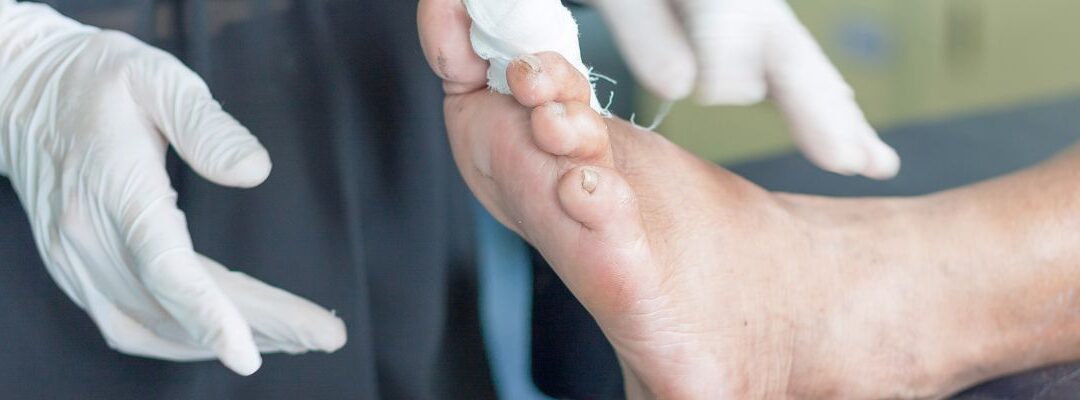 Piede diabetico sintomi, cause e prevenzione