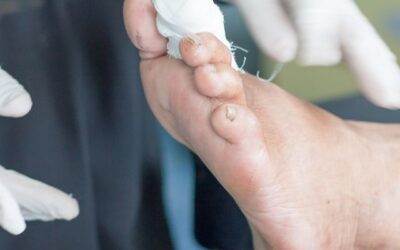 Piede diabetico: sintomi, cause e prevenzione